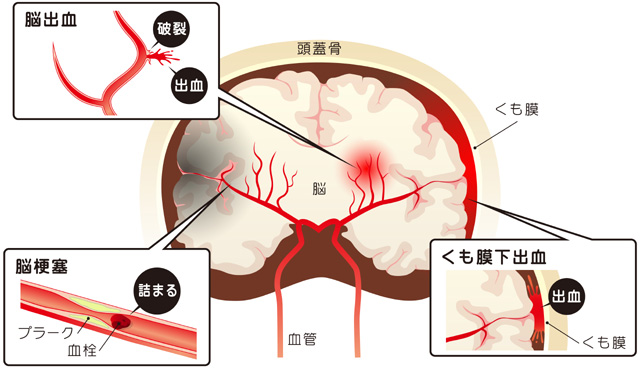 【画像】脳卒中の種類