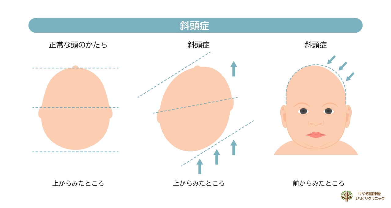 赤ちゃんの頭のかたち外来 | 東京都目黒・品川の脳神経外科 | けやき脳神経リハビリクリニック