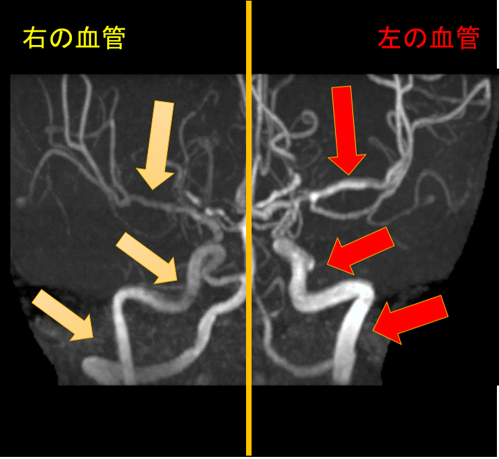 【画像】MRA