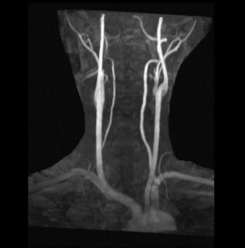 【画像】MRA　大動脈から頭
