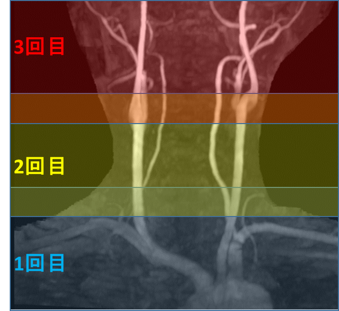 【画像】MRA　multislab