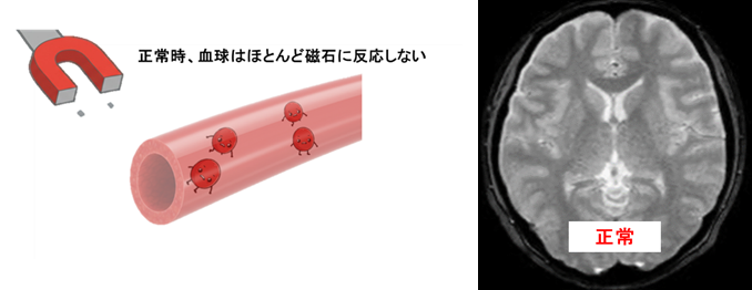 【画像】T2＊原理１