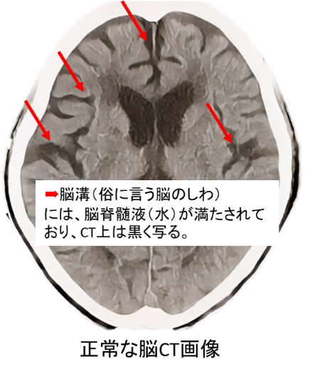 【画像】正常頭部CT