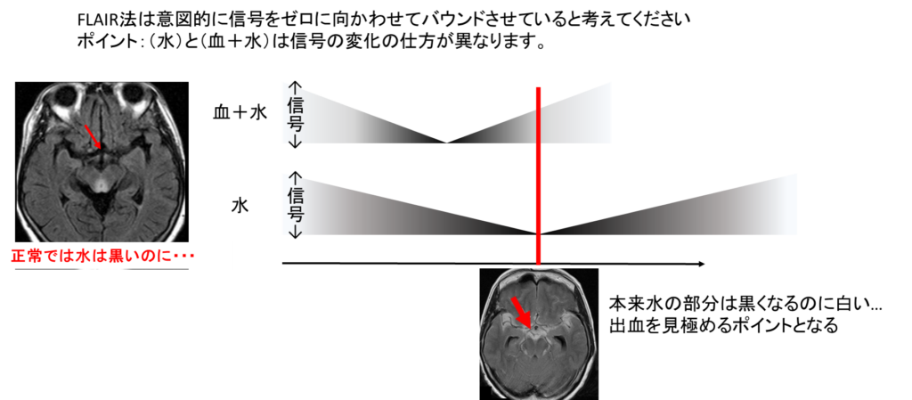 【画像】FLAIR出血時解説