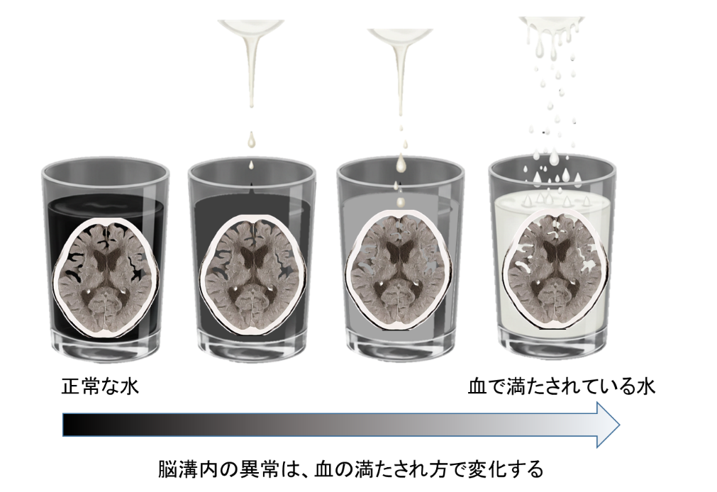 【画像】CT血腫量による見え方イメージ