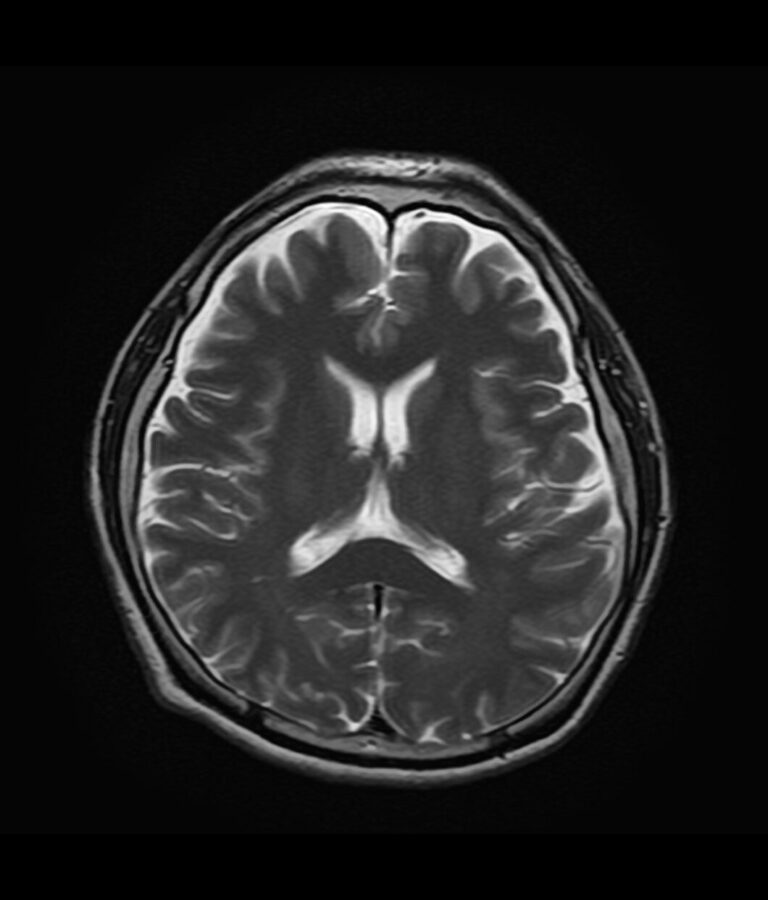 【脳ドック結果の疑問を解消】MRI画像の種類（T1, T2, FLAIR他）と見方・意味を徹底解説 | 東京都目黒・品川の脳神経外科、内科 ...