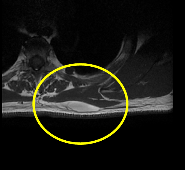 脂肪種MRI T1強調画像
