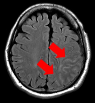 来院時MRI FLAIR