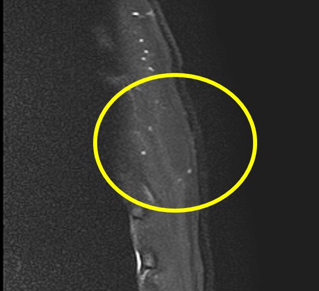 脂肪種MRI T2脂肪抑制画像