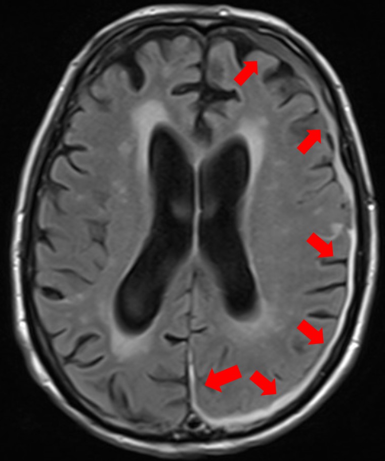 慢性硬膜下血腫MRI