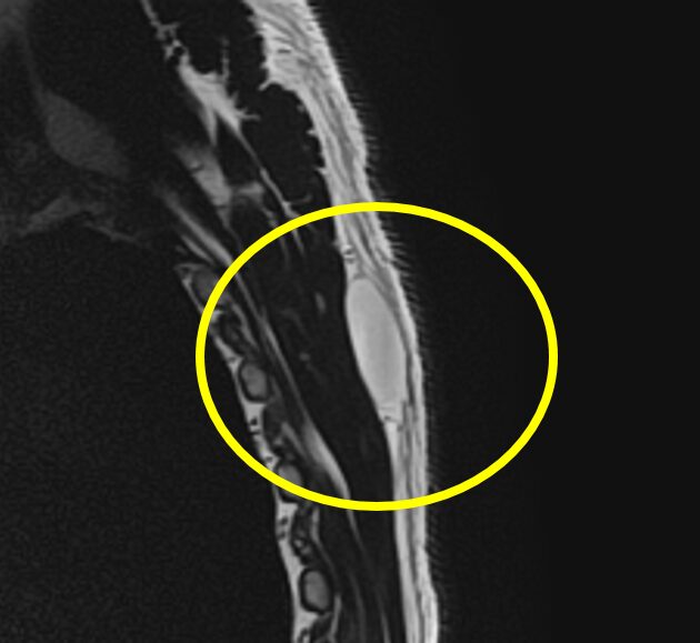 脂肪種MRI T2強調画像