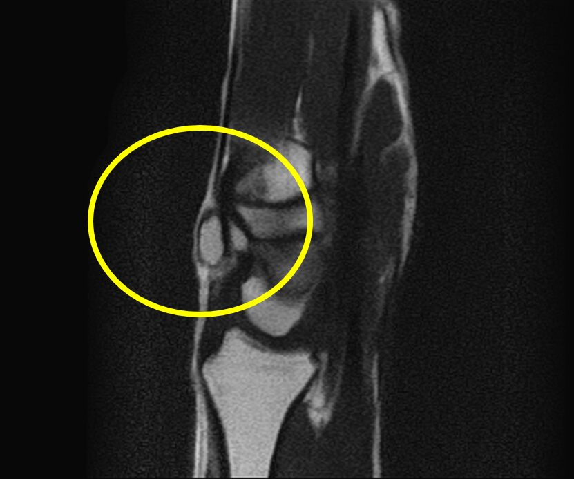 ガングリオンMRI T2