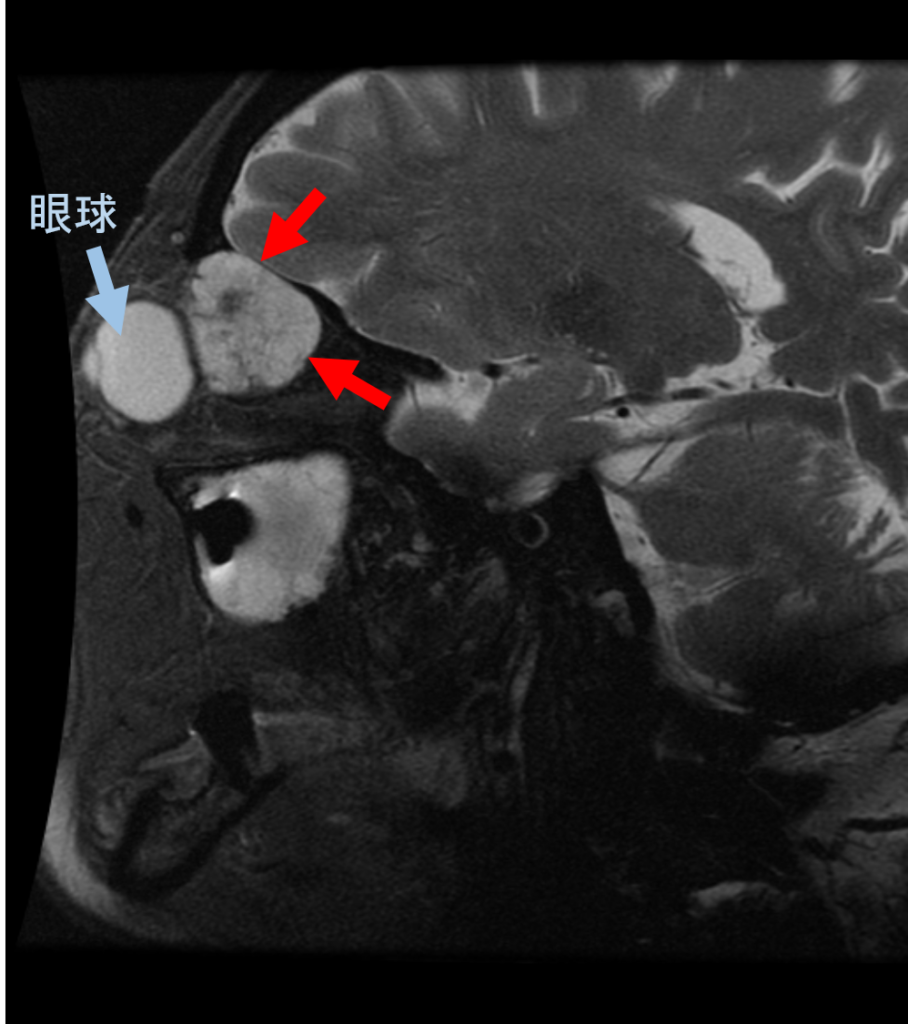 眼窩内腫瘍 脂肪抑制