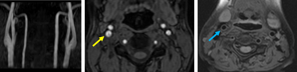 MRI 正常 頸動脈