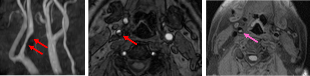 MRI 内頚動脈狭窄