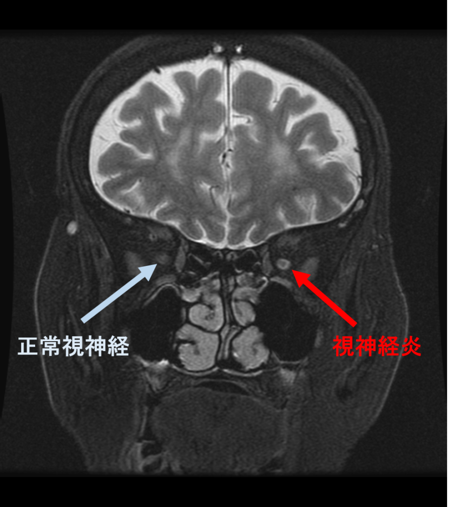 視神経炎 脂肪抑制画像
