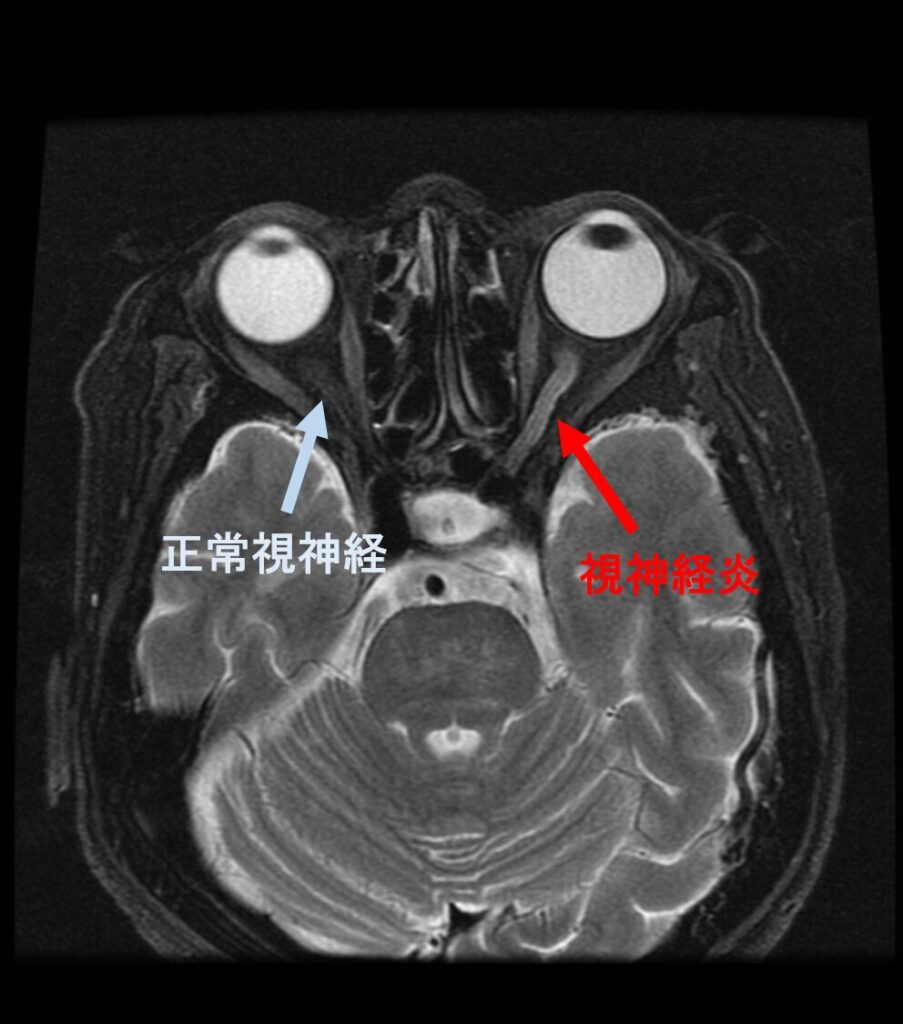 視神経炎 脂肪抑制画像