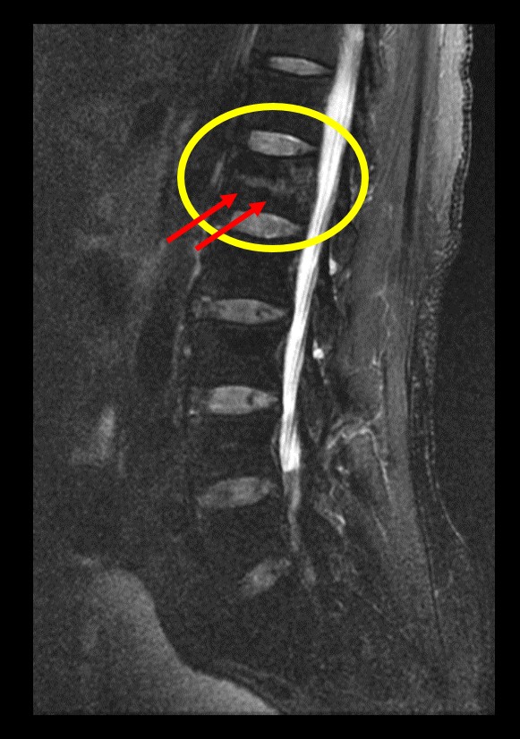 MRI　圧迫骨折
