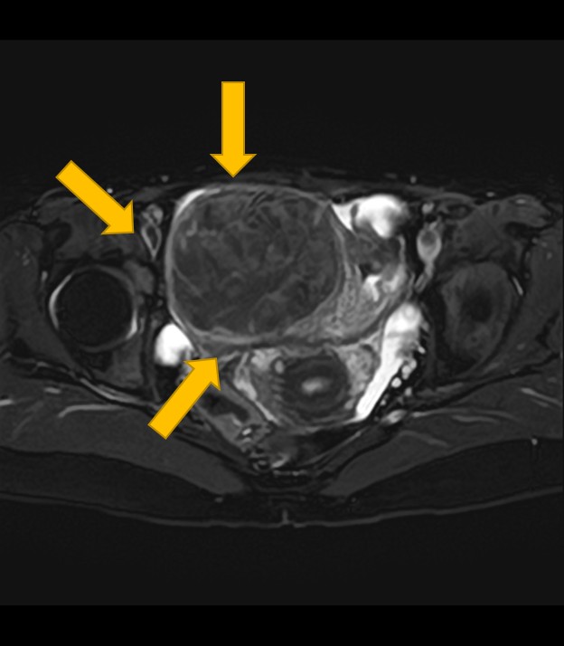 子宮筋腫 MRI