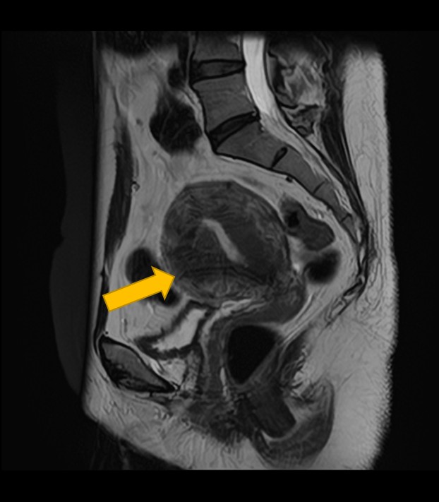 子宮腺筋症MRI