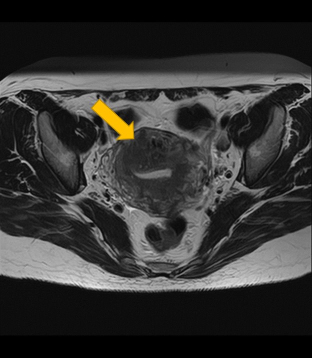 子宮腺筋症MRI