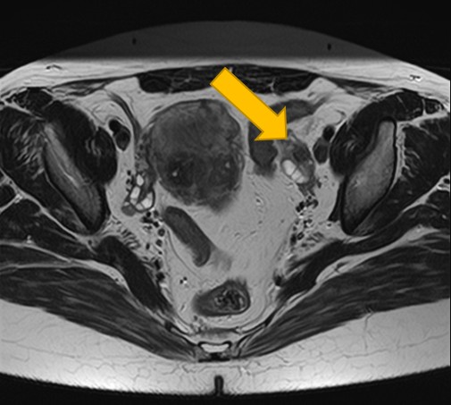 子宮内膜症性卵巣嚢胞 MRI