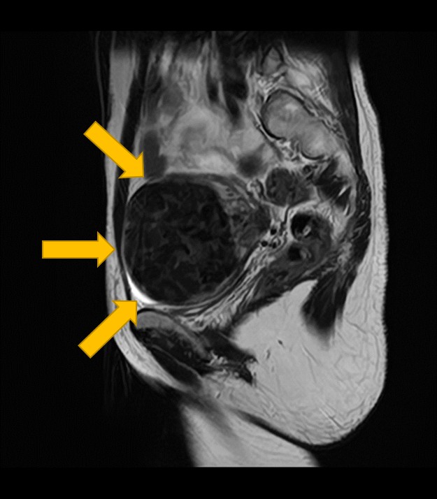 子宮筋腫 MRI