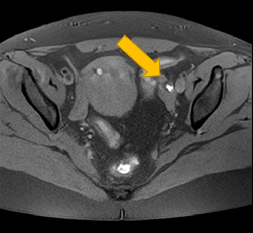 子宮内膜症性卵巣嚢胞 MRI