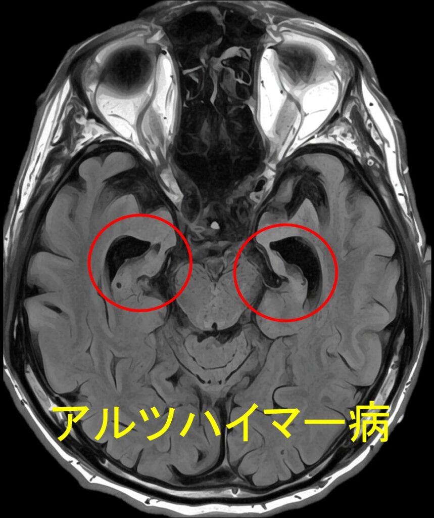 MRI　アルツハイマー病　脳