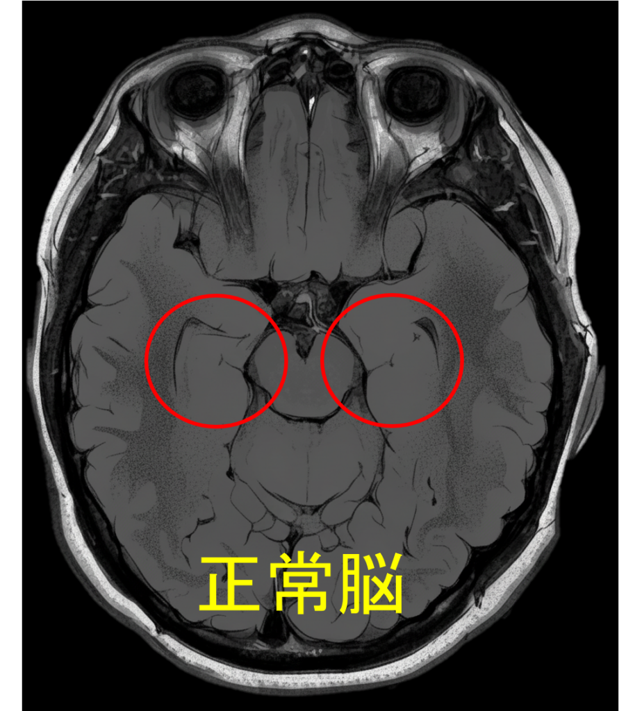 MRI　正常　脳