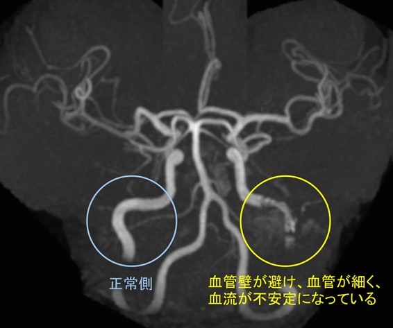 画像：内頚動脈解離