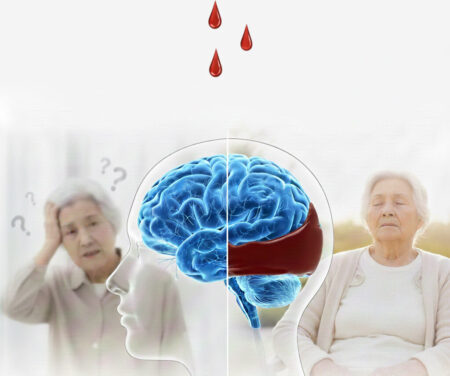 慢性硬膜下血腫