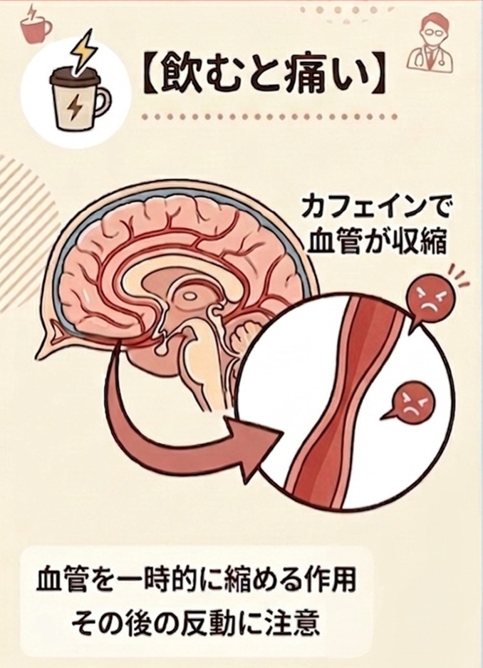 コーヒー飲むと頭痛