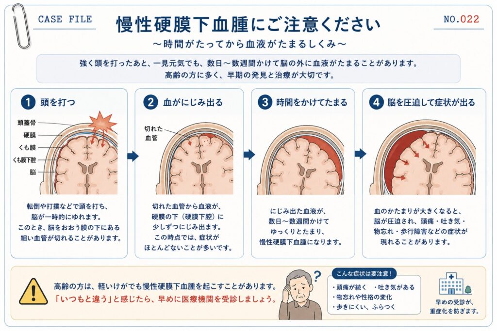 慢性硬膜下血腫ができる仕組みを解説した図解。頭をぶつけたあと、数日から数週間かけて脳の外側に血液がたまり、頭痛や歩行障害、物忘れなどの症状が現れる流れをイラストで説明。