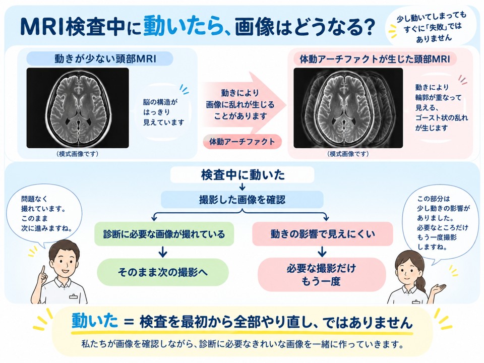 頭部MRIの通常画像と体動アーチファクトが生じた画像を比較し、動いた場合の画像確認と再撮影の流れを示した図解